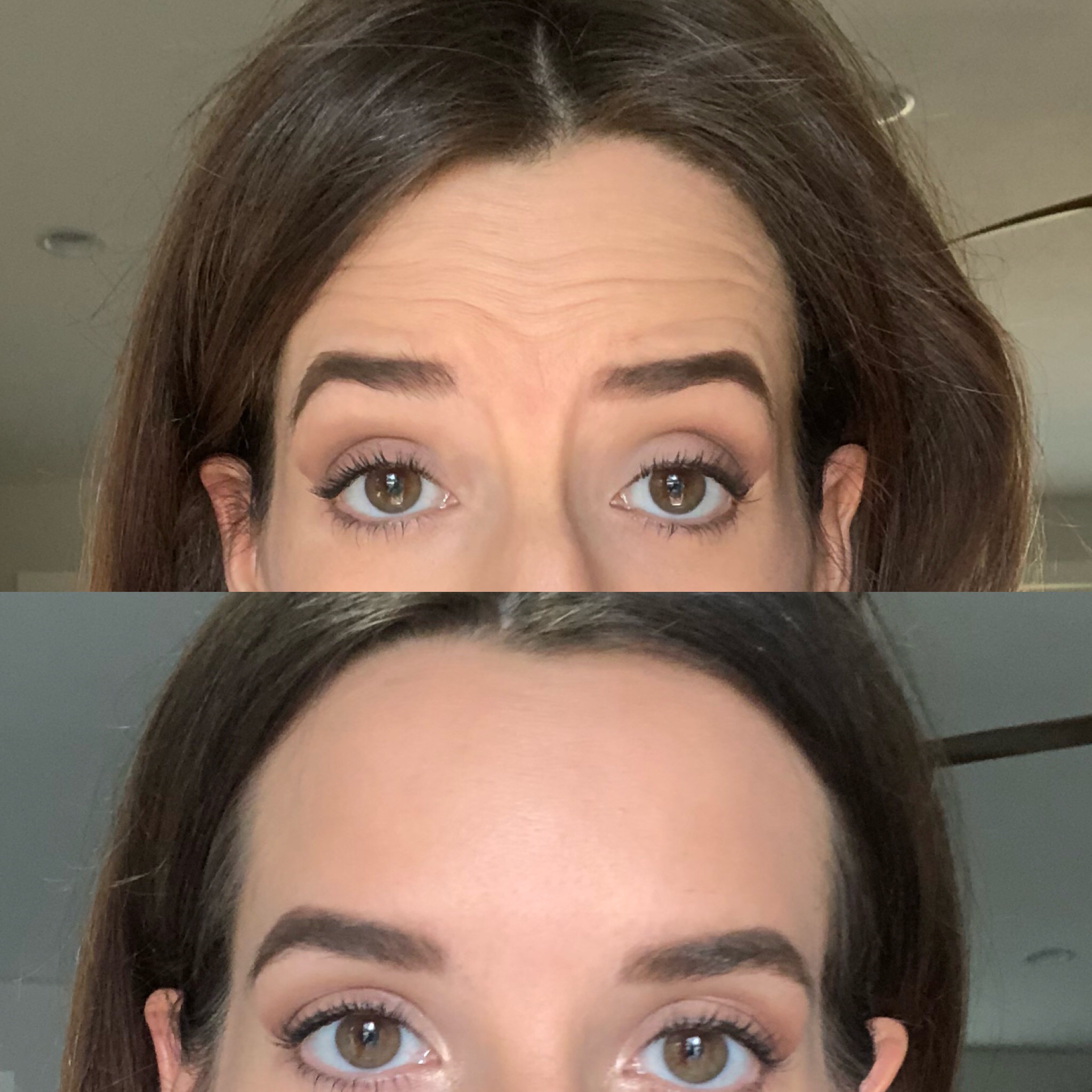 Botox Before and after 3