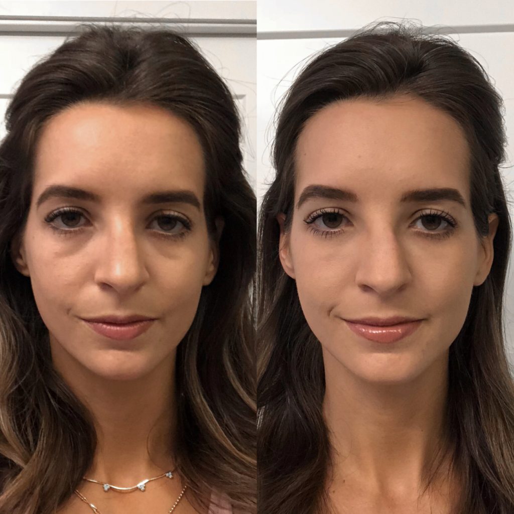 Vobella Under Eye Fillers/ Dark Circle Reduction Dallas TX Before and After