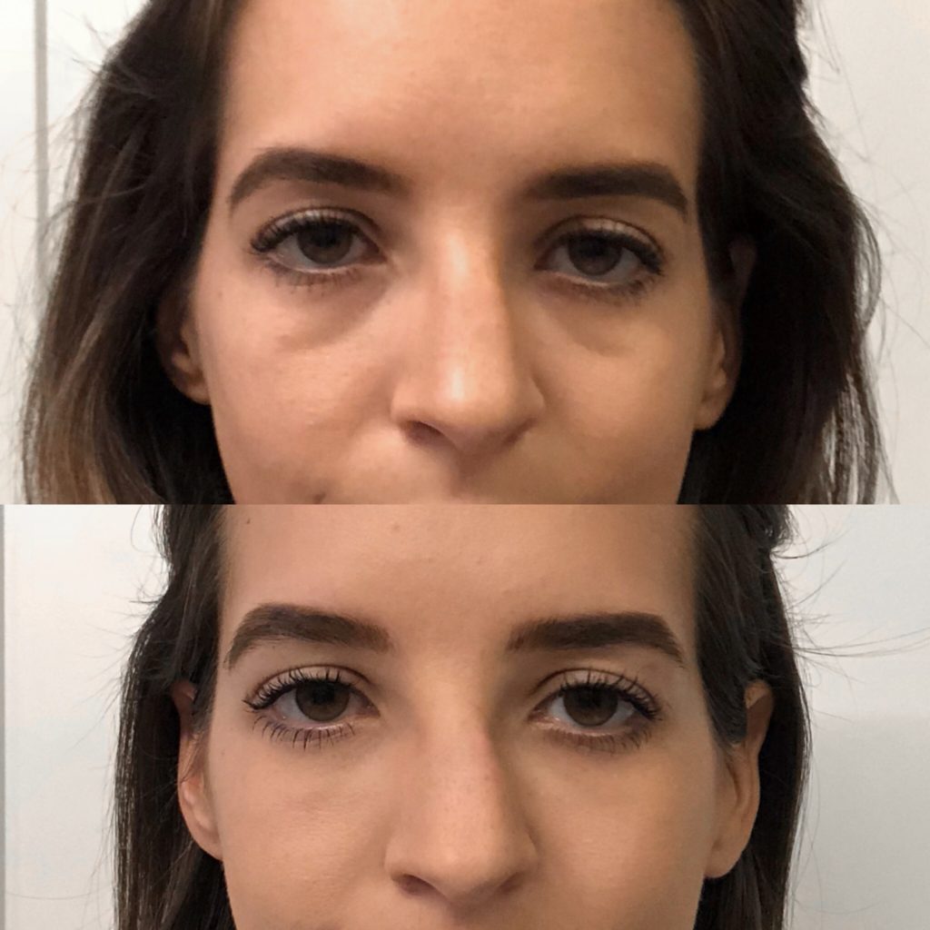 Vobella Under Eye Fillers/ Dark Circle Reduction Dallas TX