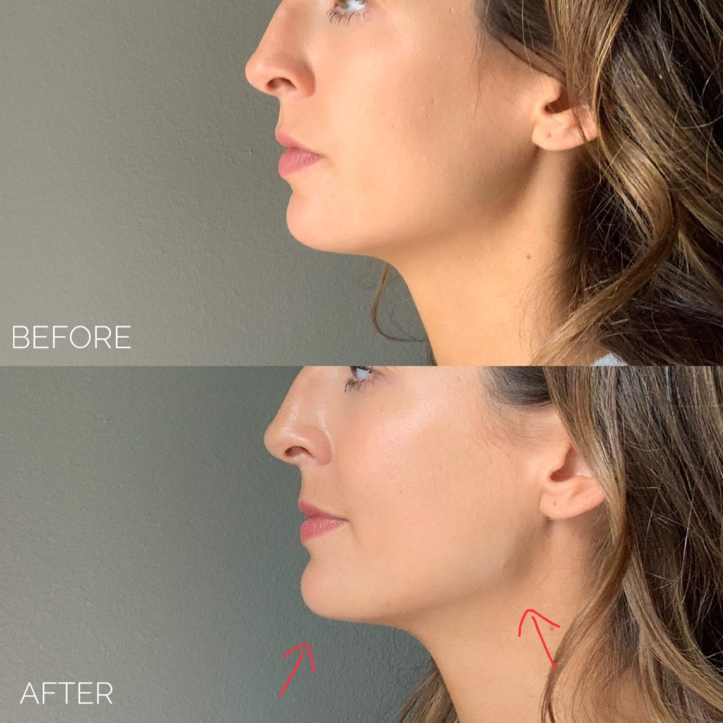 Chin and Jaw Fillers in Dallas- Enlighten Med Spa